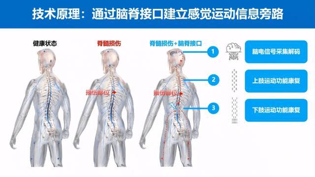 复旦团队脑脊接口研究获突破 脊髓损伤患者行走希望重启