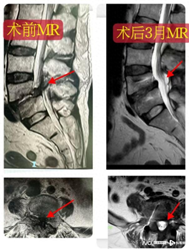 儿子给母亲吃羊胎盘滋补引发感染